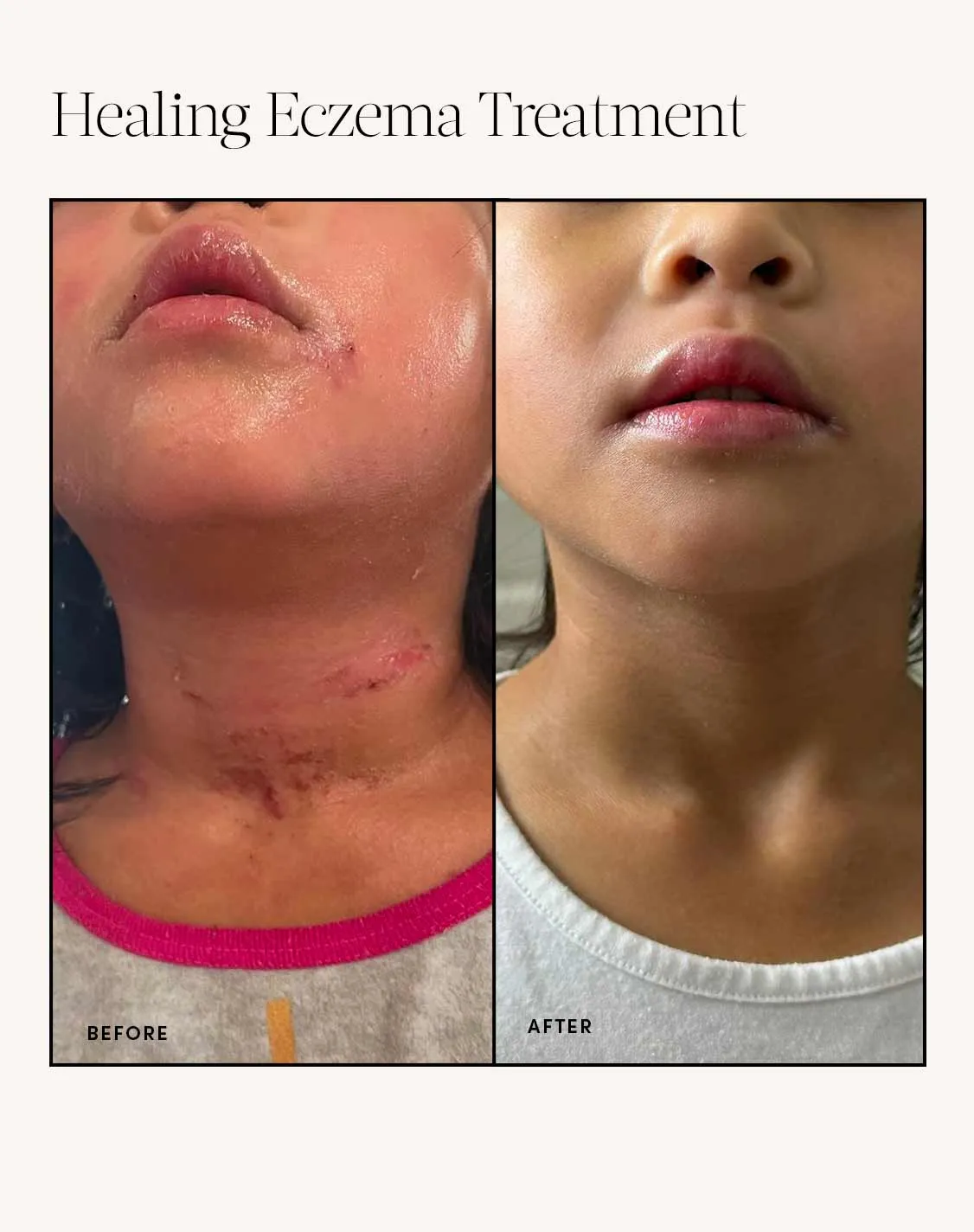 Dry Skin & Eczema Essentials Kit
